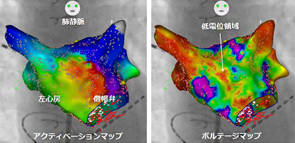 CARTO（カルト）システム画像（左心房・僧帽弁輪を反時計回りに旋回する心房頻拍）